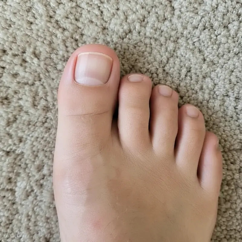 The same toenail clear and pink after FungiClear