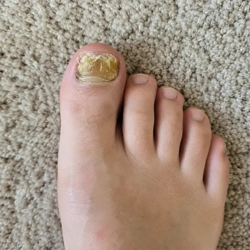 Big toenail yellow and thickened before FungiClear