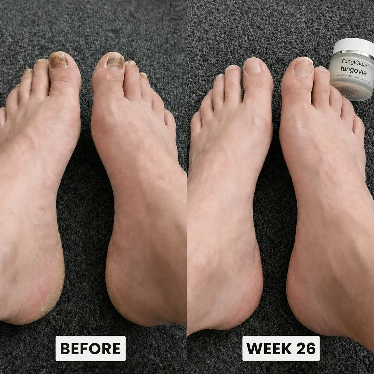 FungiClear Foot Cream — Athlete's Foot Routine